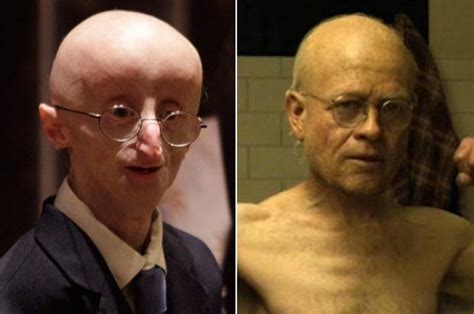 benjamin button disease real life.